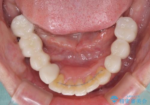 歯周病で痛い 全顎的歯周病治療の治療後