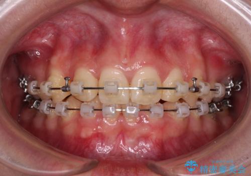 【モニター】下顎前歯の2本欠損　上顎のみの抜歯でバランスを取ったワイヤー矯正の治療中