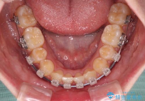 【モニター】下顎前歯の2本欠損　上顎のみの抜歯でバランスを取ったワイヤー矯正の治療中