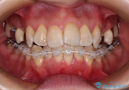 【モニター】急速拡大装置 狭い歯列を拡大してワイヤー装置で短期間治療の治療中