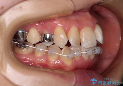 【モニター】急速拡大装置 狭い歯列を拡大してワイヤー装置で短期間治療の治療中