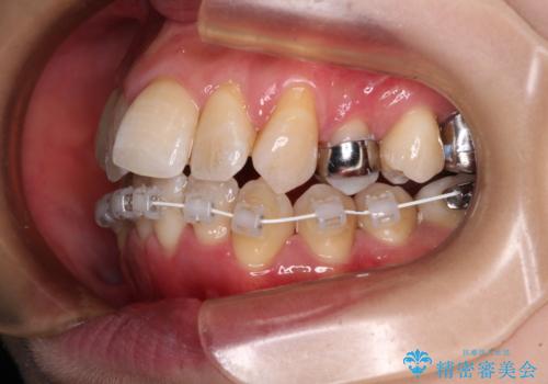 【モニター】急速拡大装置　狭い歯列を拡大してワイヤー装置で短期間治療の治療中