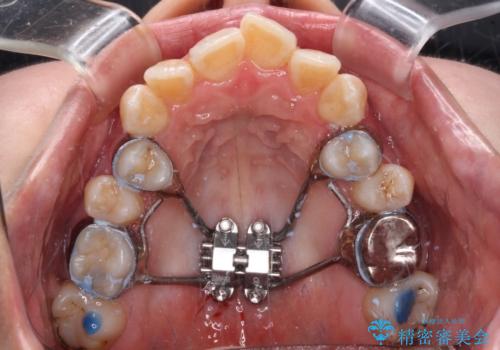 【モニター】急速拡大装置　狭い歯列を拡大してワイヤー装置で短期間治療の治療中