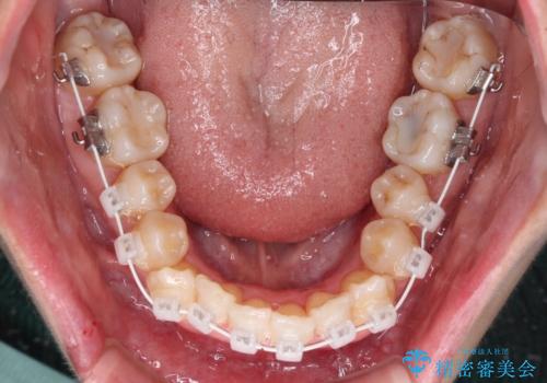 【モニター】急速拡大装置 狭い歯列を拡大してワイヤー装置で短期間治療の治療中