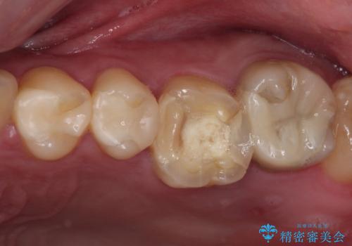 抜歯と言われた奥歯　根管治療と補綴治療の治療前