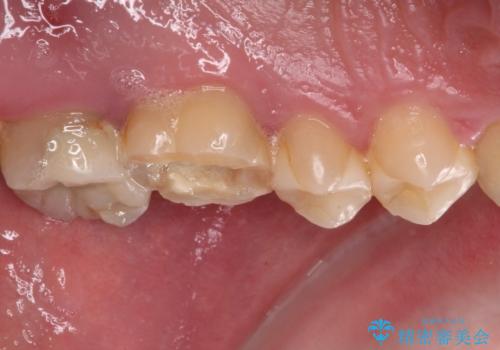 抜歯と言われた奥歯　根管治療と補綴治療の治療前