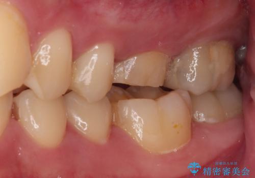 抜歯と言われた奥歯 根管治療と補綴治療の治療前