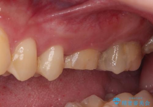 抜歯と言われた奥歯 根管治療と補綴治療の治療前