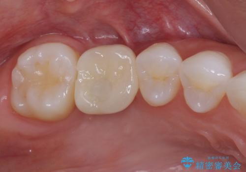 放置した奥歯の虫歯　インプラントによる欠損補綴治療の治療後