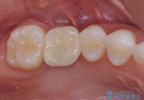 放置した奥歯の虫歯　インプラントによる欠損補綴治療の症例 治療後