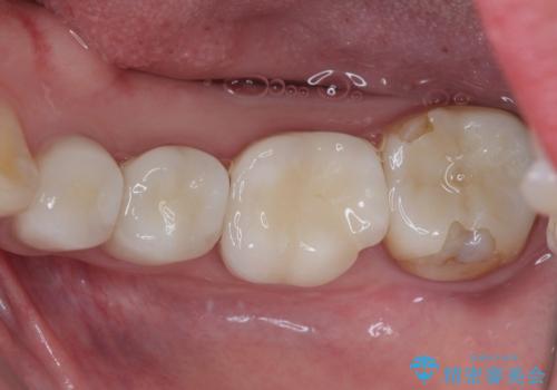 見た目の不揃いなセラミックを統一感のある歯にの治療後
