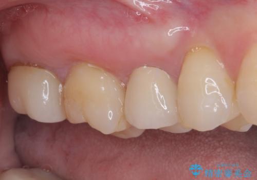 見た目の不揃いなセラミックを統一感のある歯にの治療後