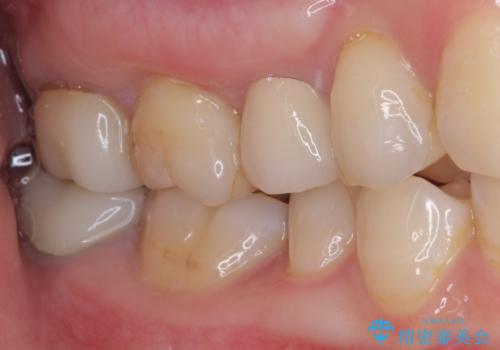見た目の不揃いなセラミックを統一感のある歯にの治療後
