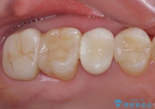 見た目の不揃いなセラミックを統一感のある歯にの治療後