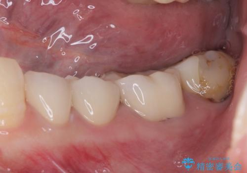 見た目の不揃いなセラミックを統一感のある歯にの治療後