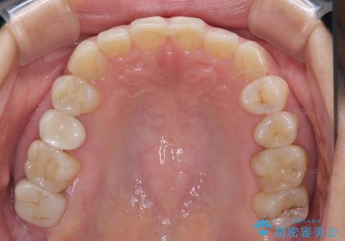 見た目の不揃いなセラミックを統一感のある歯にの治療後
