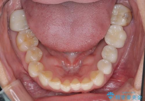 見た目の不揃いなセラミックを統一感のある歯にの治療後