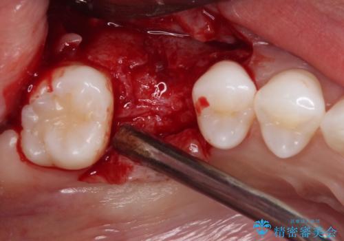 放置した奥歯の虫歯　インプラントによる欠損補綴治療の治療前
