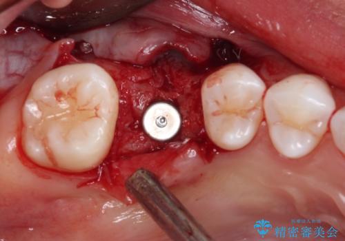 放置した奥歯の虫歯　インプラントによる欠損補綴治療の治療中
