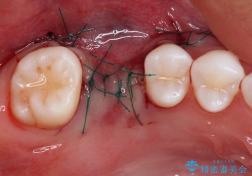 放置した奥歯の虫歯　インプラントによる欠損補綴治療の治療後