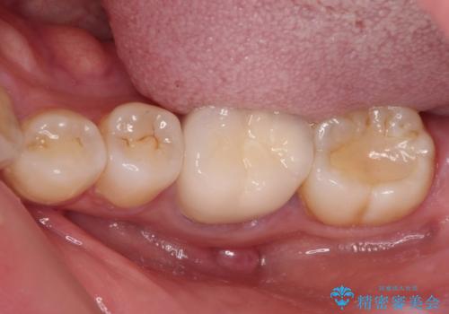 指摘された虫歯　オールセラミッククラウンによる補綴治療の治療前