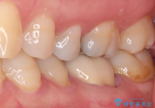 指摘された虫歯 オールセラミッククラウンによる補綴治療の治療前