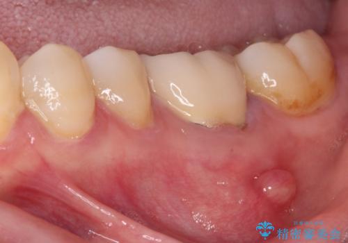 指摘された虫歯　オールセラミッククラウンによる補綴治療の治療前