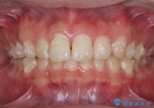 出っ歯が気になる 歯をぬかずに治療の治療中