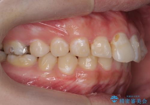 出っ歯が気になる 歯をぬかずに治療の治療中