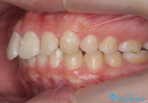 出っ歯が気になる 歯をぬかずに治療の治療中