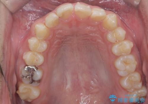 出っ歯が気になる 歯をぬかずに治療の治療中