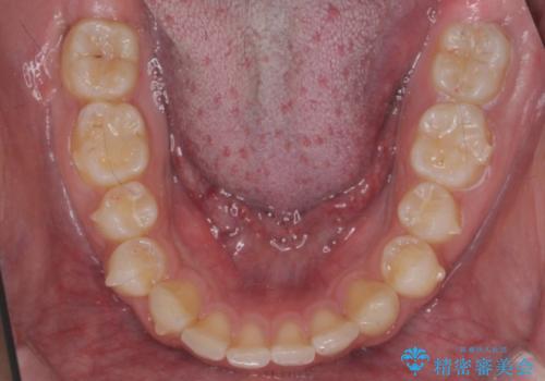 出っ歯が気になる 歯をぬかずに治療の治療中