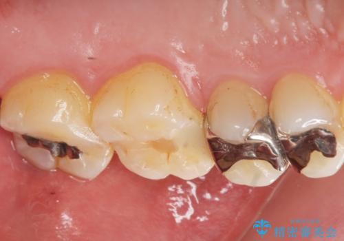 銀が目立つので白くしたいの治療前