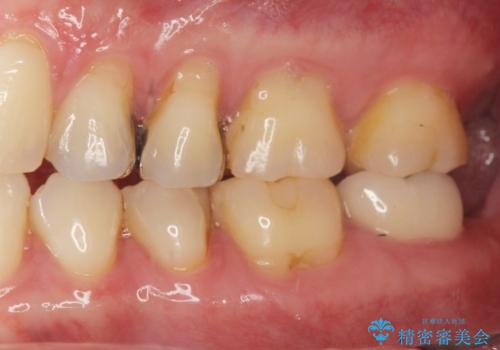 銀が目立つので白くしたいの治療前