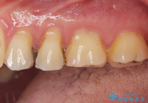 銀が目立つので白くしたいの治療前