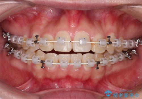 舌突出癖による開咬 舌のトレーニングを行いながら咬み合わせを改善の治療中