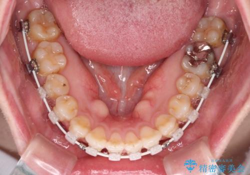 舌突出癖による開咬 舌のトレーニングを行いながら咬み合わせを改善の治療中