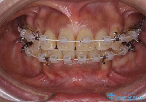 クロスバイトの前歯を治したい　ワイヤー装置でも抜歯矯正の治療中