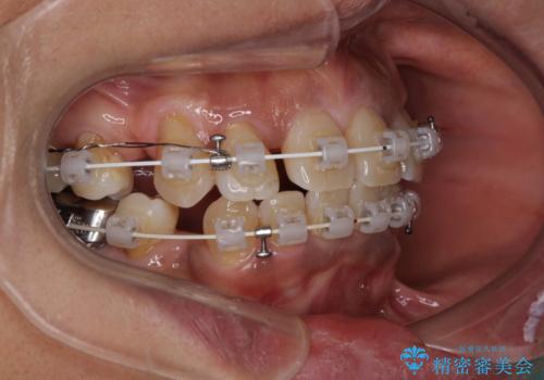 クロスバイトの前歯を治したい ワイヤー装置でも抜歯矯正の治療中