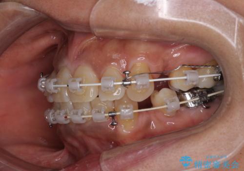 クロスバイトの前歯を治したい　ワイヤー装置でも抜歯矯正の治療中