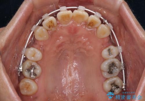 クロスバイトの前歯を治したい ワイヤー装置でも抜歯矯正の治療中