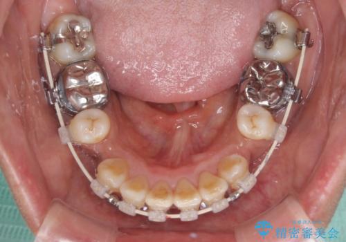 クロスバイトの前歯を治したい ワイヤー装置でも抜歯矯正の治療中