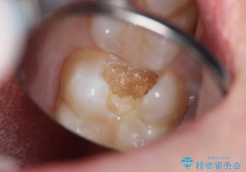 【VPT(歯髄温存療法)とセラミックインレー】深い虫歯でも神経を残したいの治療中