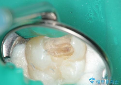 【VPT(歯髄温存療法)とセラミックインレー】深い虫歯でも神経を残したいの治療中