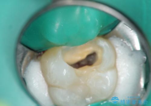 【VPT(歯髄温存療法)とセラミックインレー】深い虫歯でも神経を残したいの治療中