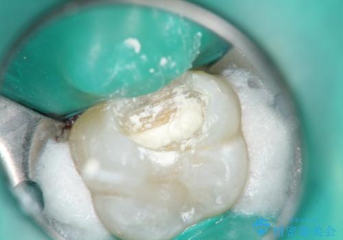 【VPT(歯髄温存療法)とセラミックインレー】深い虫歯でも神経を残したい