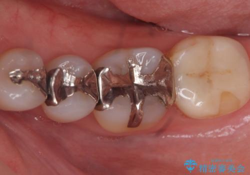 詰め物のやりかえ希望