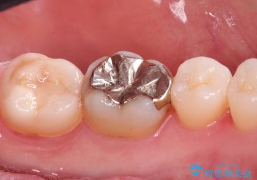 e-maxインレー治療の治療前