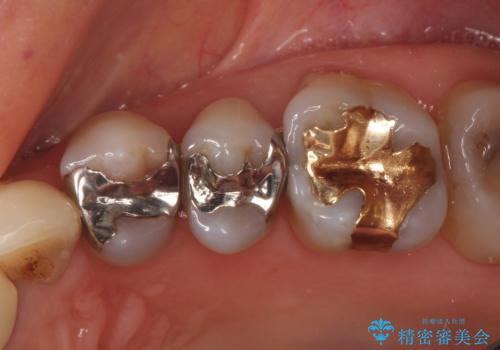 【オールセラミッククラウン】銀歯の下に大きな虫歯の症例 治療前