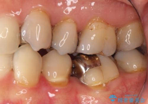 【オールセラミッククラウン】銀歯の下に大きな虫歯の治療前